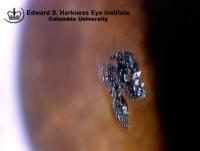 A piece of metallic solder material lodged superficially on the cornea.